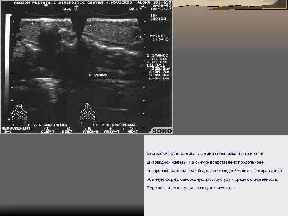 Структурные изменения щитовидной. Фокальные изменения щитовидной железы УЗИ. Гемигенезия доли щитовидной железы УЗИ. Агенезия доли щитовидной железы на УЗИ. Очаговое образование левой доли щитовидной железы что это такое.