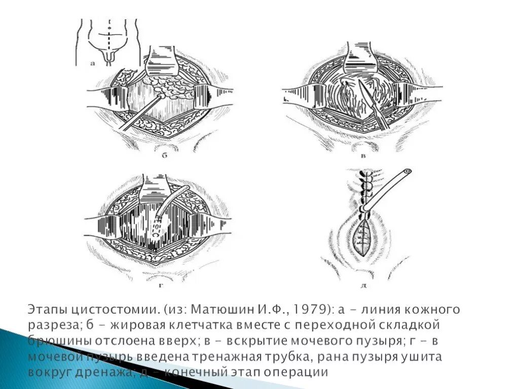 Лапаротомия что это такое простыми словами. Разрез по переходной складке. Разрез по Пфанненштилю используется при операциях. Послойный разрез по Пфанненштилю. Разрез по Пфанненштилю операция.