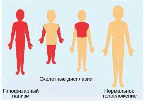 Церебрально гипофизарный нанизм. Гипофизарный нанизм (карликовость). Карликовость симпотом.