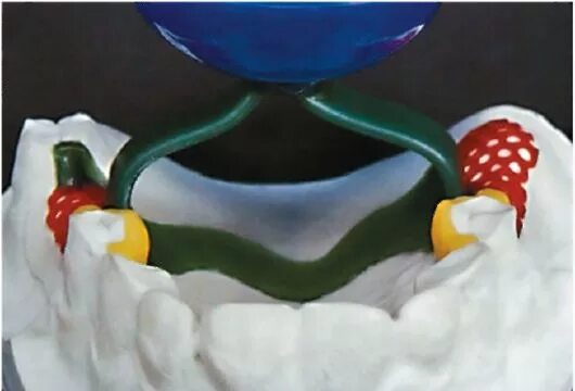 Литниковая система каркаса бюгельного протеза. Бюгель литниковая система. Литниковая система каркаса бюгельного протеза. Литниковая система бюгельного протеза. Литье каркаса бюгельного протеза.