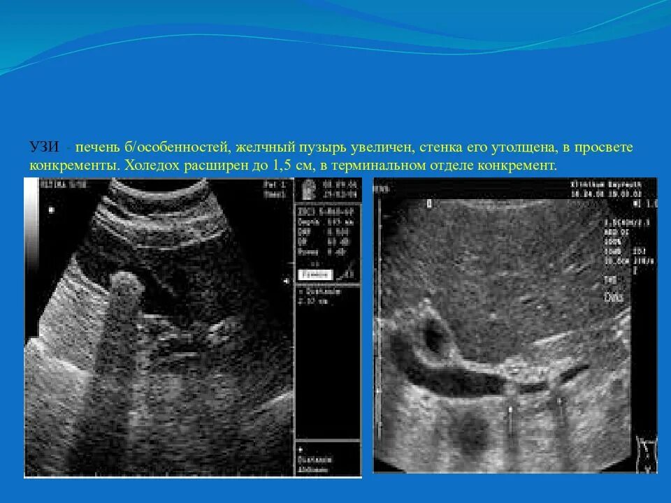 Увеличен желчный пузырь у взрослого. Расширенный холедох на УЗИ. Холедох 6 мм в желчном пузыре что это такое. Холедох и желчный пузырь на УЗИ. Холедох желчного пузыря что это.