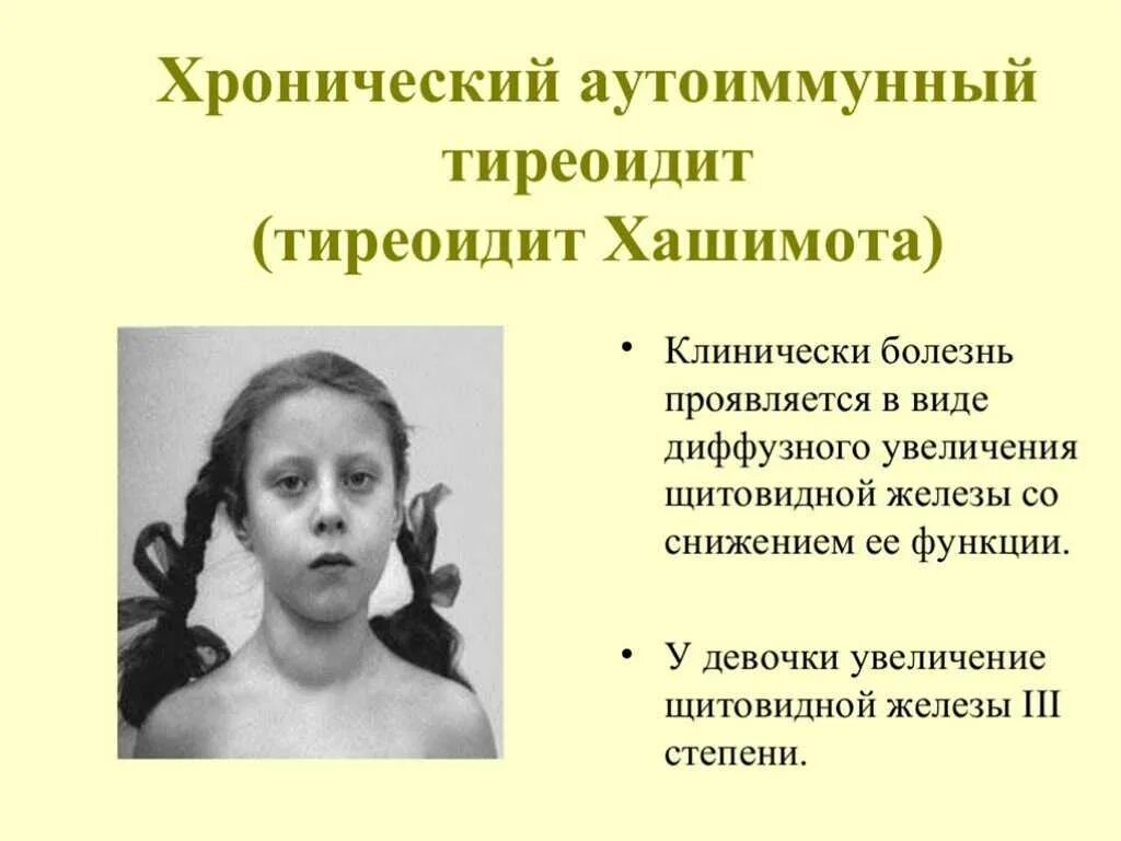 Слово гипертиреоз