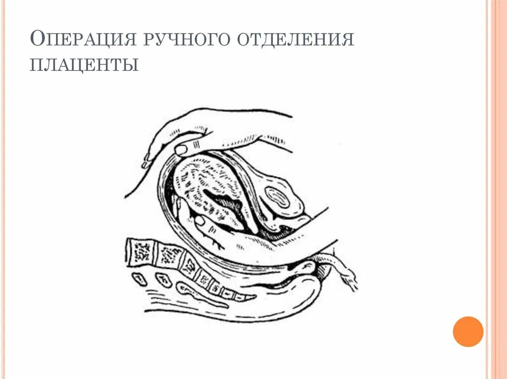 Ручное отделения последа техника операции. Ручное отделение и выделение последа техника. Операция ручного отделения и выделения последа. Операция ручного отделения плаценты.