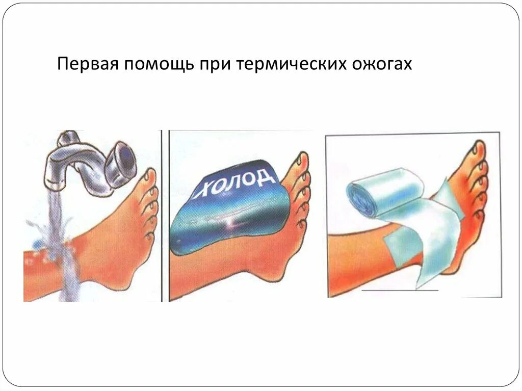 Первая мед при ожогах. Первая помощь при ожогах термических ожогах. Оказание при первой помощи при термических ожогах. Порядок оказания первой помощи при термических ожогах второй степени. Оказание ПМП при термических ожогах.