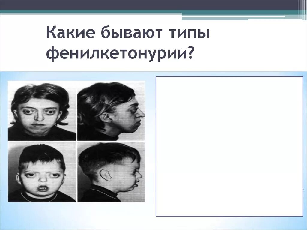Дети с фенилкетонурией как выглядят ازدواج فامیلی خطر ابتلای نوزاد به فنیل کتونوری را افزایش می دهد