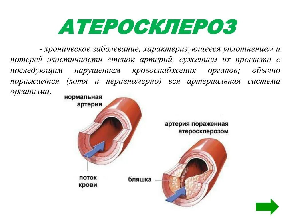 Сколько хроническое заболевание. Атеросклероз презентация. Атеросклеротическое поражение сосудов. Атеросклероз картинки.