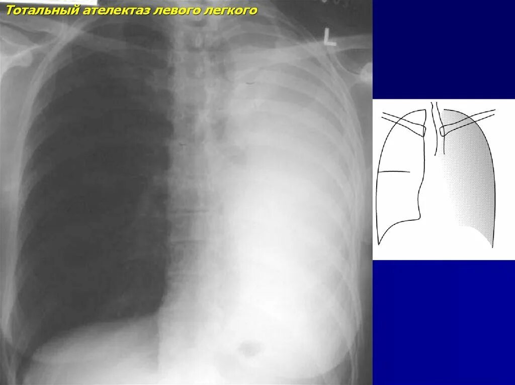 Гидроторакс ателектаз. Компрессионный ателектаз рентген. Ателектаз легкого на рентгеновском снимке. Компрессионный ателектаз легкого