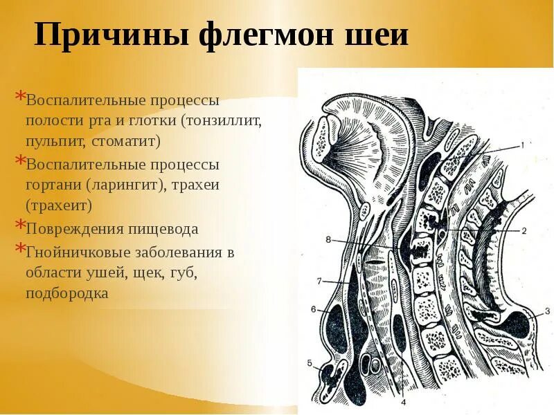 Локализация флегмон шеи. Операция абсцесс шеи