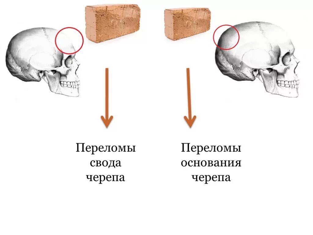 Перелом основания свода