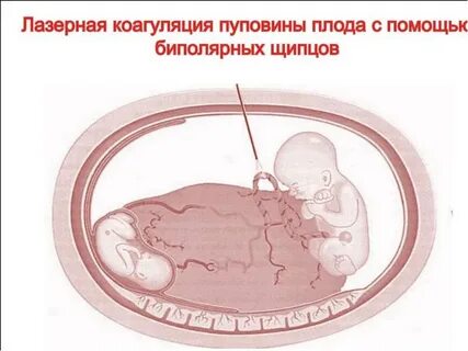 Тяж соединяющий зародыш с плацентой