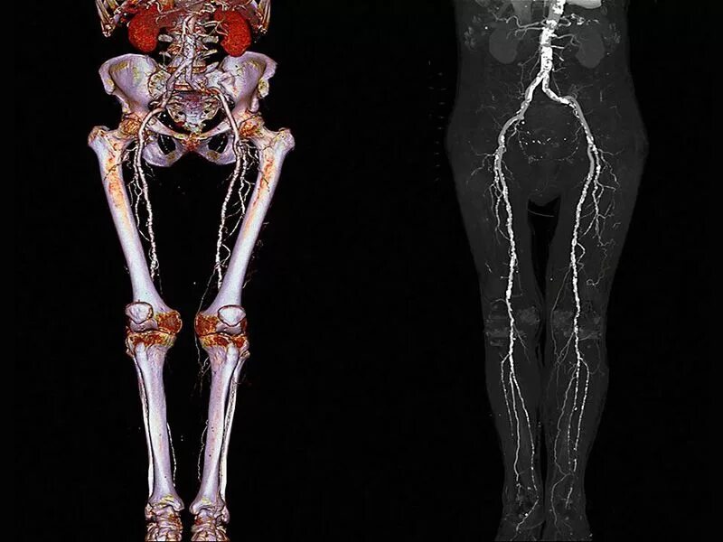 Нижних конечностей и головного мозга. Кт ангиография сосудов нижних конечностей. МСКТ артерий нижних конечностей. МСКТ ангиография сосудов нижних конечностей. Кт сосудов нижних конечностей с контрастированием.