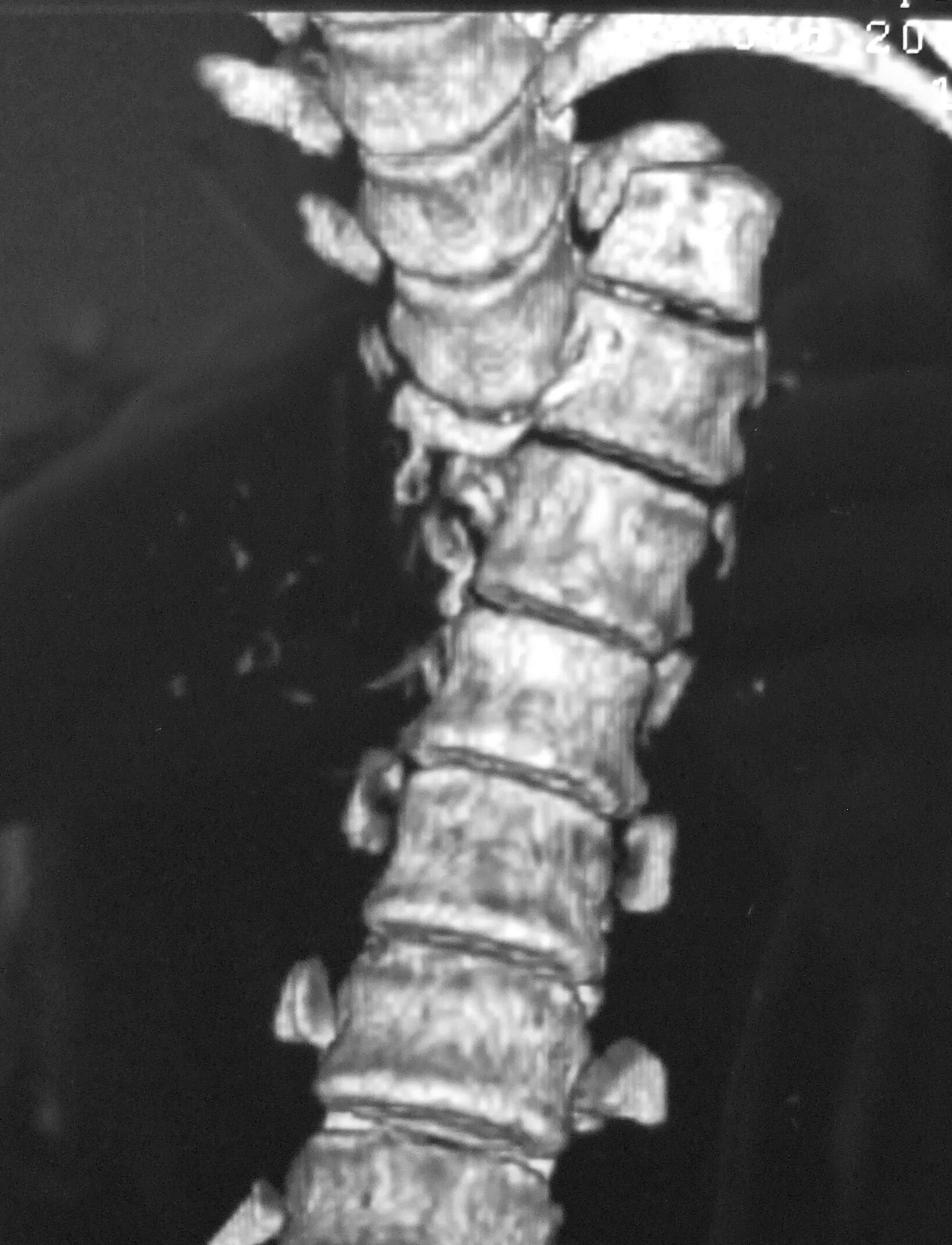 Дистракционный перелом позвоночника кт. Перелом грудного отдела позвоночника рентген. Снимок рентген перелом позвоночника.