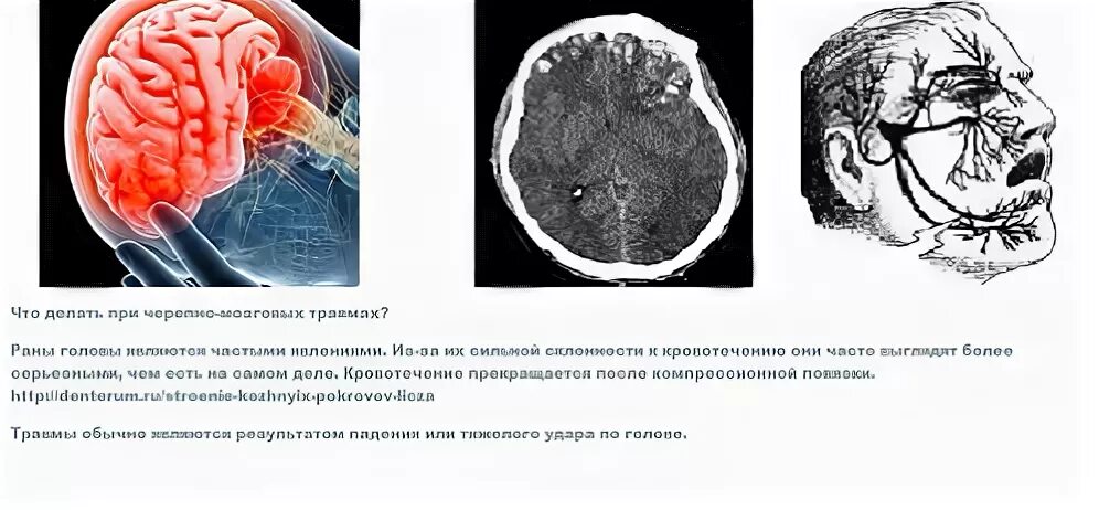 Последствия сотрясения мозгов. Последствия после сотрясения мозга. Последствия после сотрясения. Последствия сотрясения головного. Деформация черепа при сотрясении мозга.