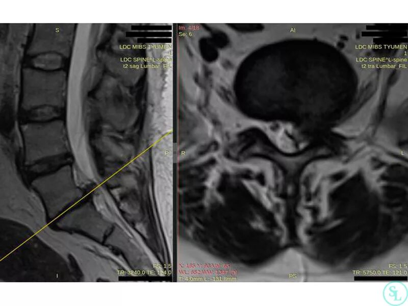 Медианно парамедианная билатеральная. Грыжа l5-s1. Парамедианная грыжа l5 s1. Парамедианная секвестрированная грыжа l5 s1. Медианная грыжа l5-s1.