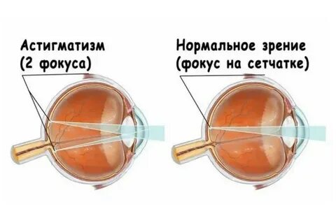 Сложный астигматизм обоих