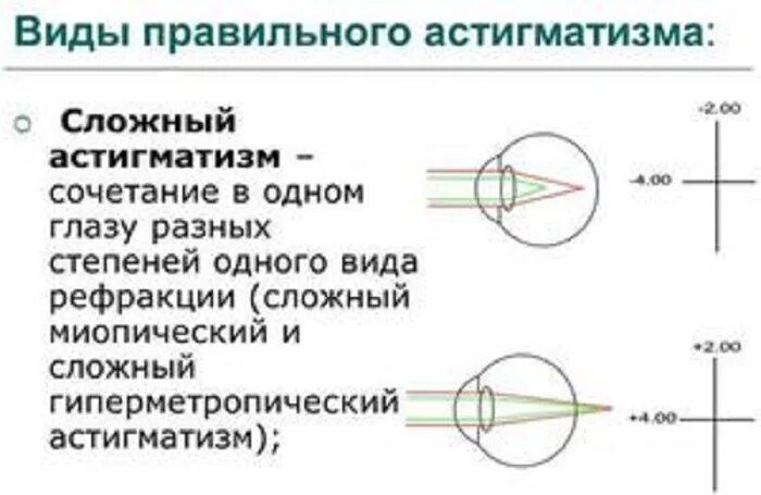 Сложный гиперметропический астигматизм 1 степени. Миопия слабой степени сложный миопический астигматизм. Астигматизм (виды, принципы коррекции).. Диагноз глаз сложный миопический астигматизм. Сложный гиперметропический астигматизм глаз