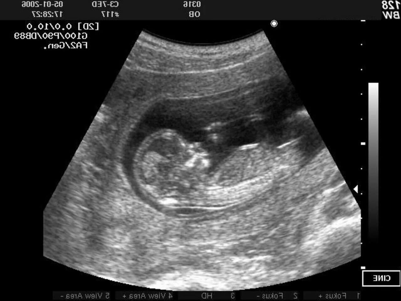 1 узи 12 недель. 1 Скрининг при беременности УЗИ. УЗИ 1 триместр беременности фото. УЗИ 1 скрининг. УЗИ ребенка на 12 неделе беременности.