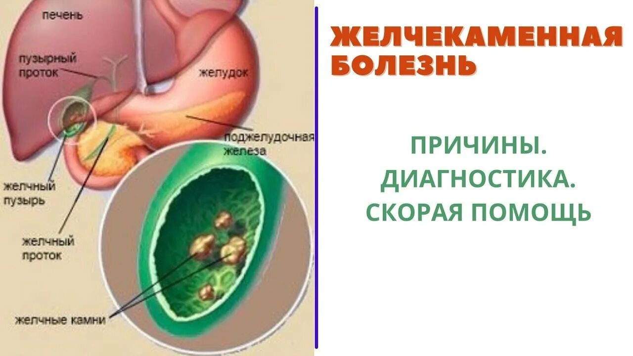 Приступы желчного пузыря при камнях. Желчекаменная болезнь. Желчнокаменная болезнь. Желчекп желчекаменная болезнь. Желчнокаменная болезнь картинки.