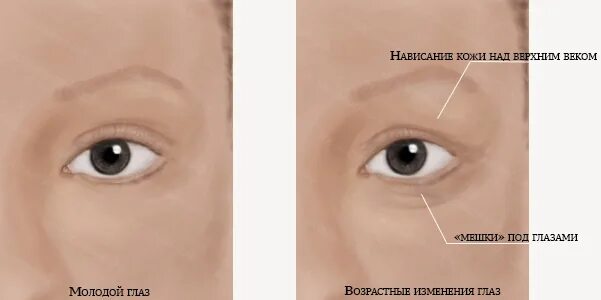 Почему веко верхнее нависло. Нависание кожи над верхним веком. Нависание верхнего века на одном глазу. Избыточное нависание кожи верхнего века это. Отсутствие нависание верхнего века.