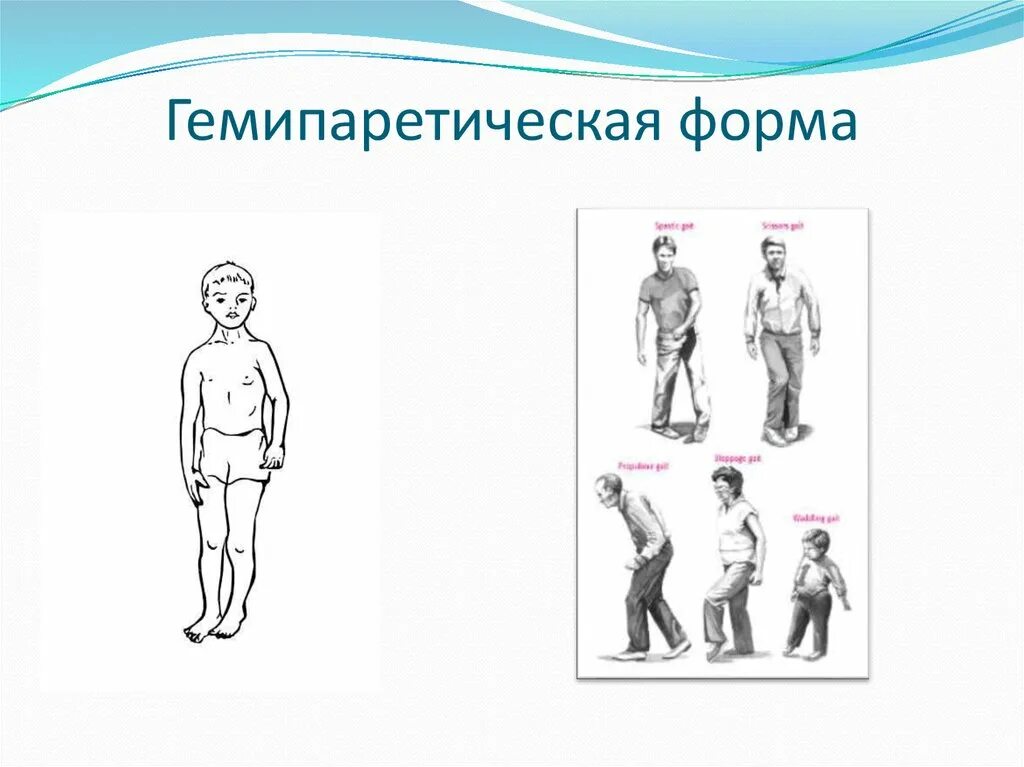 Гемиплегия симптомы. Формы дцп гемипаретическая форма. двойная гемиплегия это форма дцп. характеристики гемипаретической формы дцп. дцп гемиплегическая форма левосторонний гемипарез.