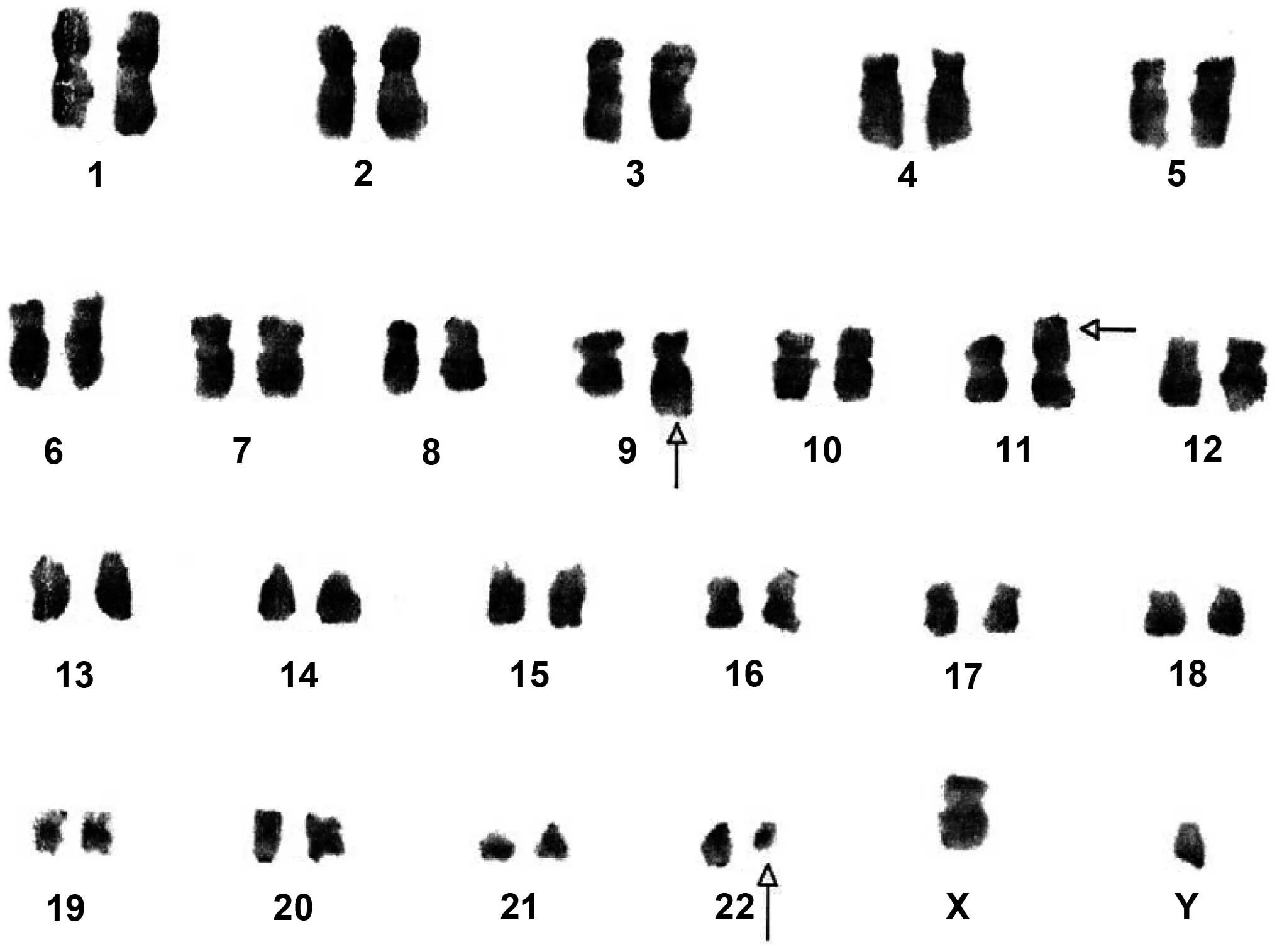 22- Кариотип. Синдром филадельфийской хромосомы кариотип. Инверсия 9 хромосомы кариотип. Кариотип XY.