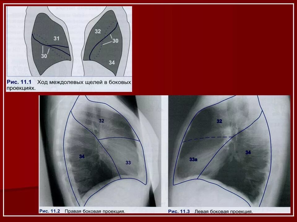 Пневмоторакс боковая проекция рентген. Плеврит рентген боковая проекция. Междолевая плевра легкого. Рентгеноанатомия грудины. Легкие в прямой проекции