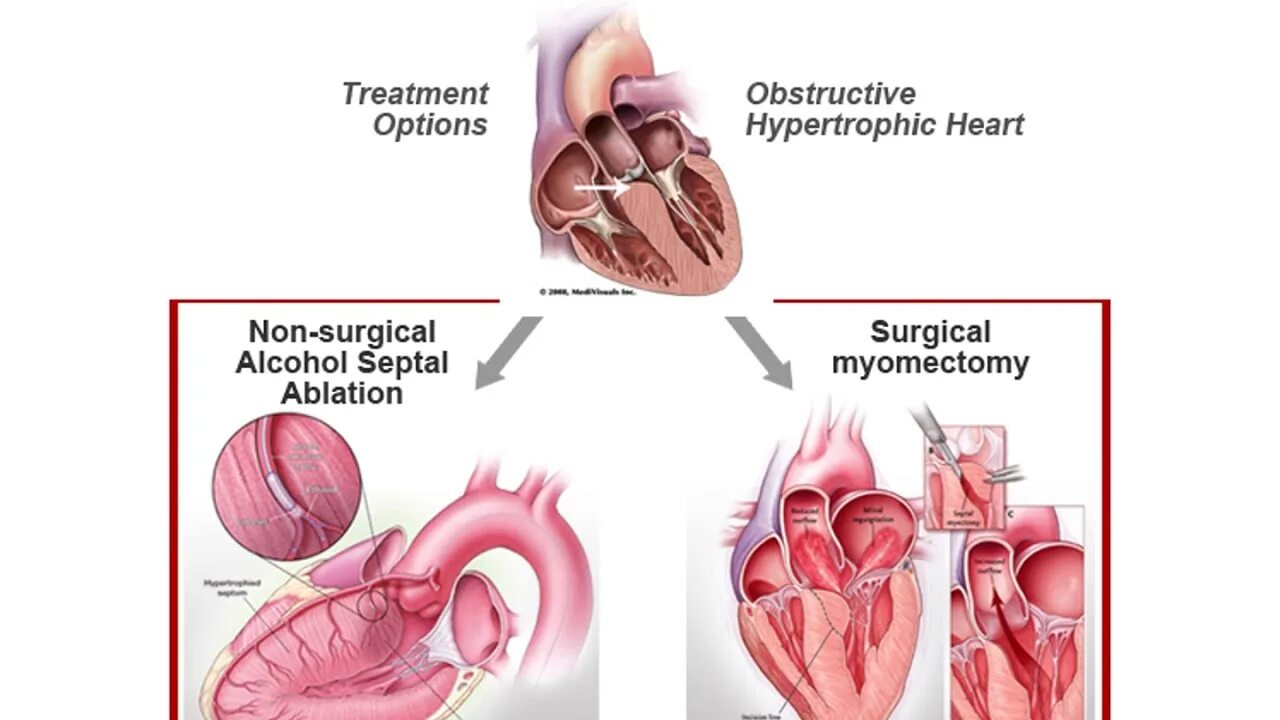 Чрезаортальная септальная миэктомия. Необструктивная кардиомиопатия. Климактерическая кардиомиопатия. Септальная миоэктомия сердца. Миоэктомия