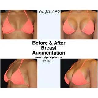Pre Bra Size: 32B Post Bra Size: 34C 5'4" 115 lbs. #breastaug #br...