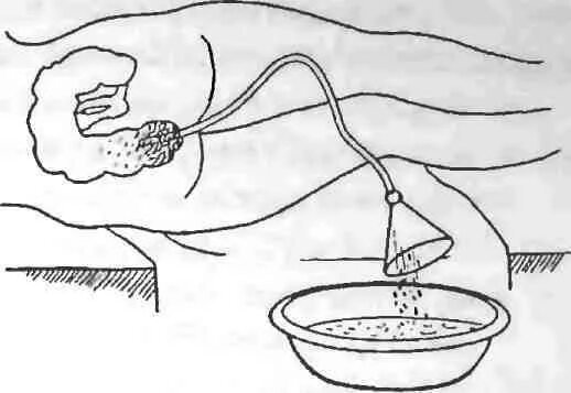Промывание желудка сифонная клизма алгоритм. Сифонная клизма алгоритм. Сифонная клизма алгоритм выполнения. Сифонная клизма 20 литров.