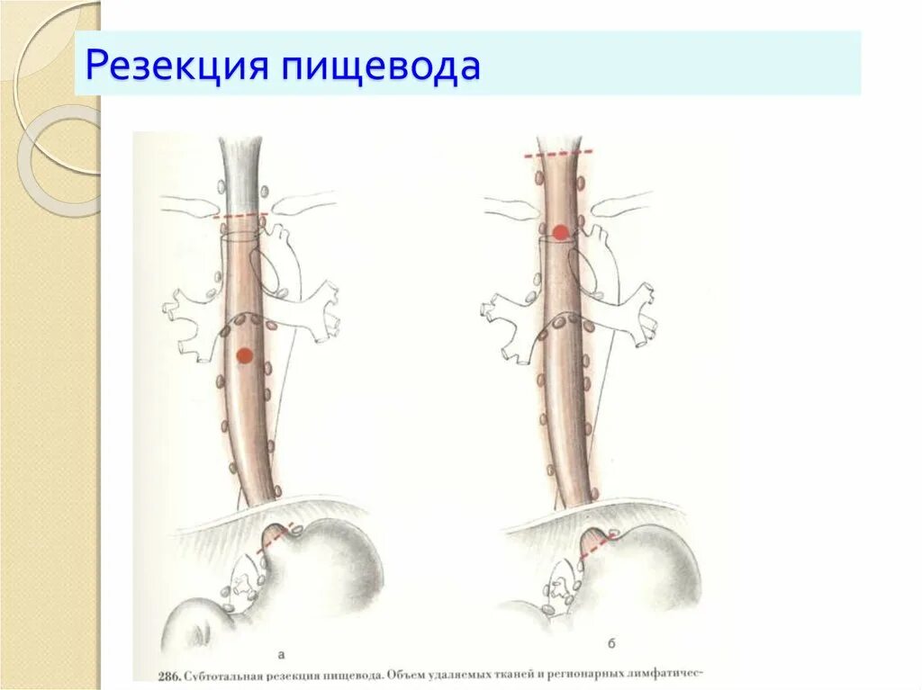 Резекция пищевода операции. Резекция нижней трети пищевода.