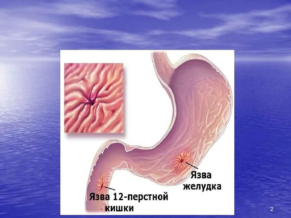 Болезни двенадцатиперстной кишки у ребенка. Язва желудка и 12 перстной кишки. Язвенная болезнь желудка и 12 перстной кишки у детей. Язва желудка и 12 перстной кишки терапия. Язва 12перстной кишки возникновение.