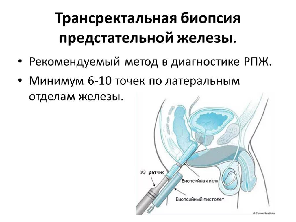 Сколько времени делается биопсия предстательной железы. Методика выполнения биопсии предстательной железы. мультифокальная трансректальная биопсия простаты. трузи с биопсией предстательной железы. биопсия опухоли простаты.