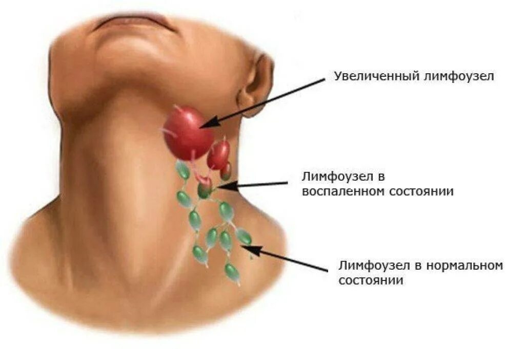 Лимфогранулематоз лимфоузлов. Лимфогранулематоз лимфоузлы. Лимфоузел воспалились лимфатические. Лимфоузлы на шее воспаление. Увеличены лимфоузлы нормы