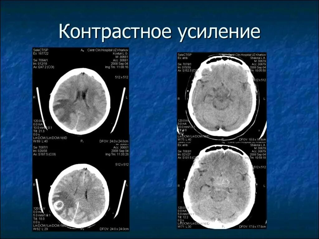 Контрастное усиление. Кт с контрастным усилением. Контрастное вещество для кт голова. Контрастное усиление при кт. Разница кт и кт с контрастом