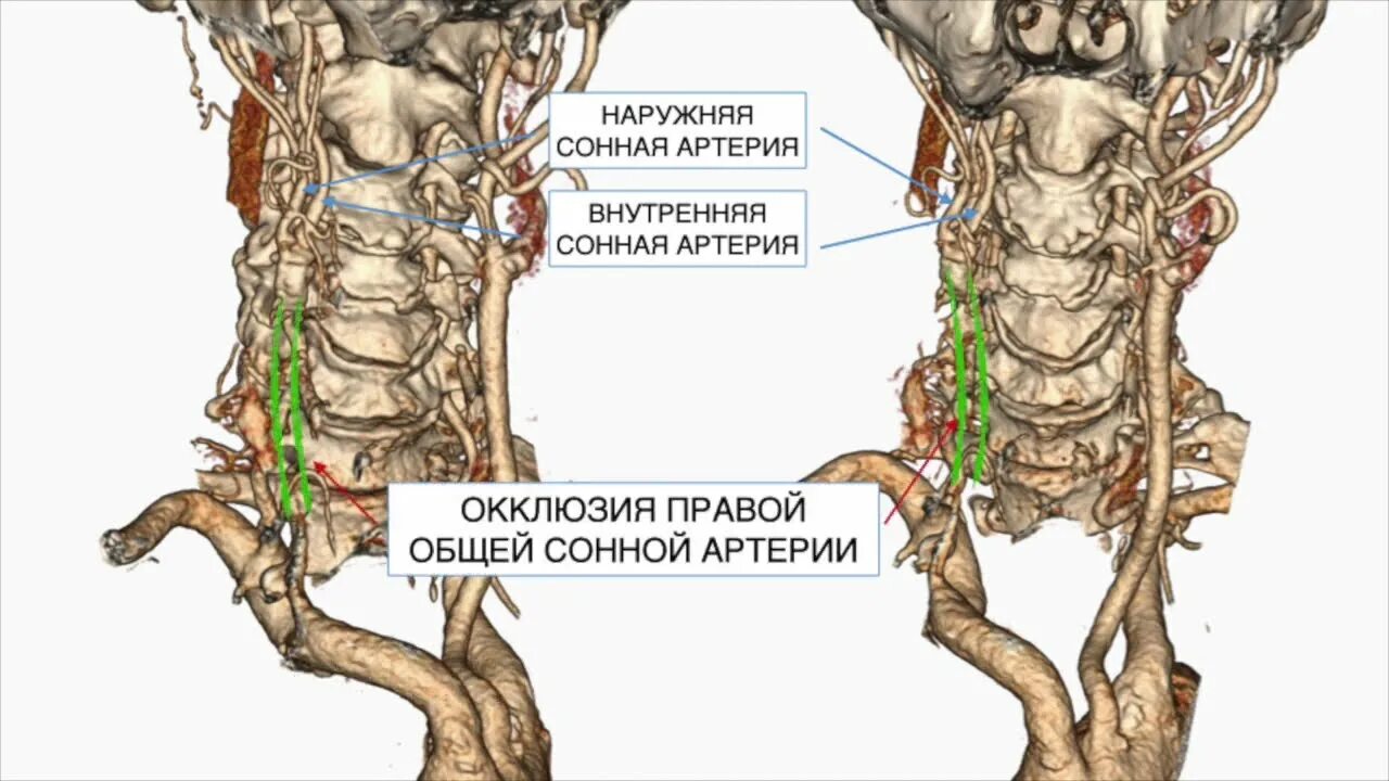 Каротидная эндартерэктомия. Эверсионной каротидной эндартерэктомии. Эндартерэктомия сонной артерии. Каротидная эндартерэктомия сонной артерии Эверсионная. Эверсионная каротидная эндартерэктомия