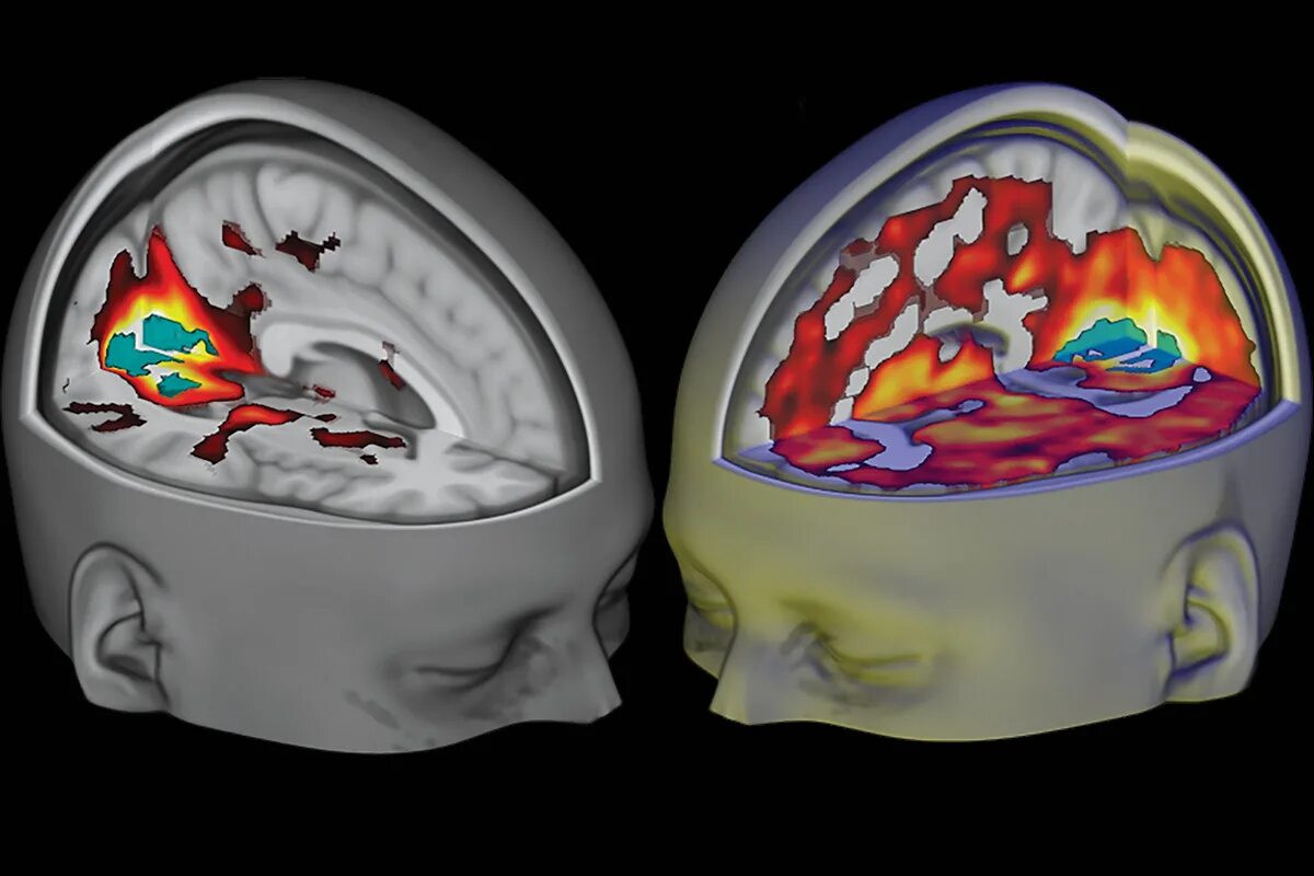 Диффузные ирритативные. Мрт мозга под лсд. Мозг под псилоцибином. Мозг человека под лсд. Мозг под грибами.