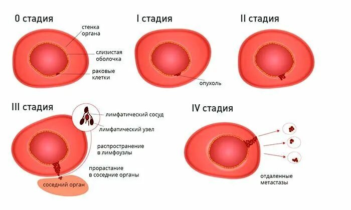 Сколько по времени развивается рак. Стадии опухолевого процесса. Перечислите стадии развития злокачественных опухолей. Стадия опухолевого процесса 1а.