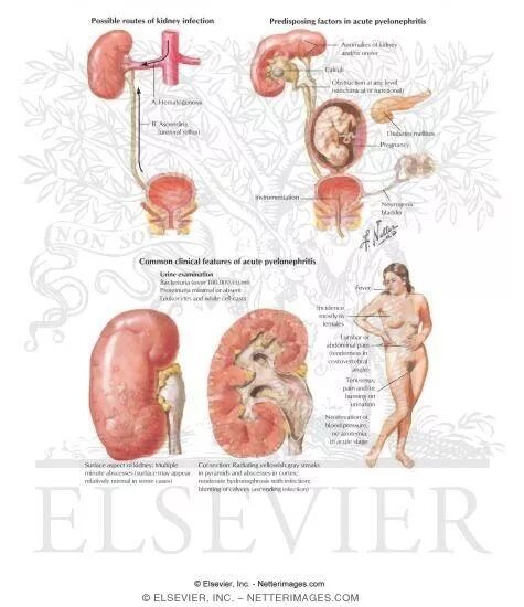 Гестационный пиелонефрит. Гестагенный пиелонефрит. Пиелонефрит у беременных.