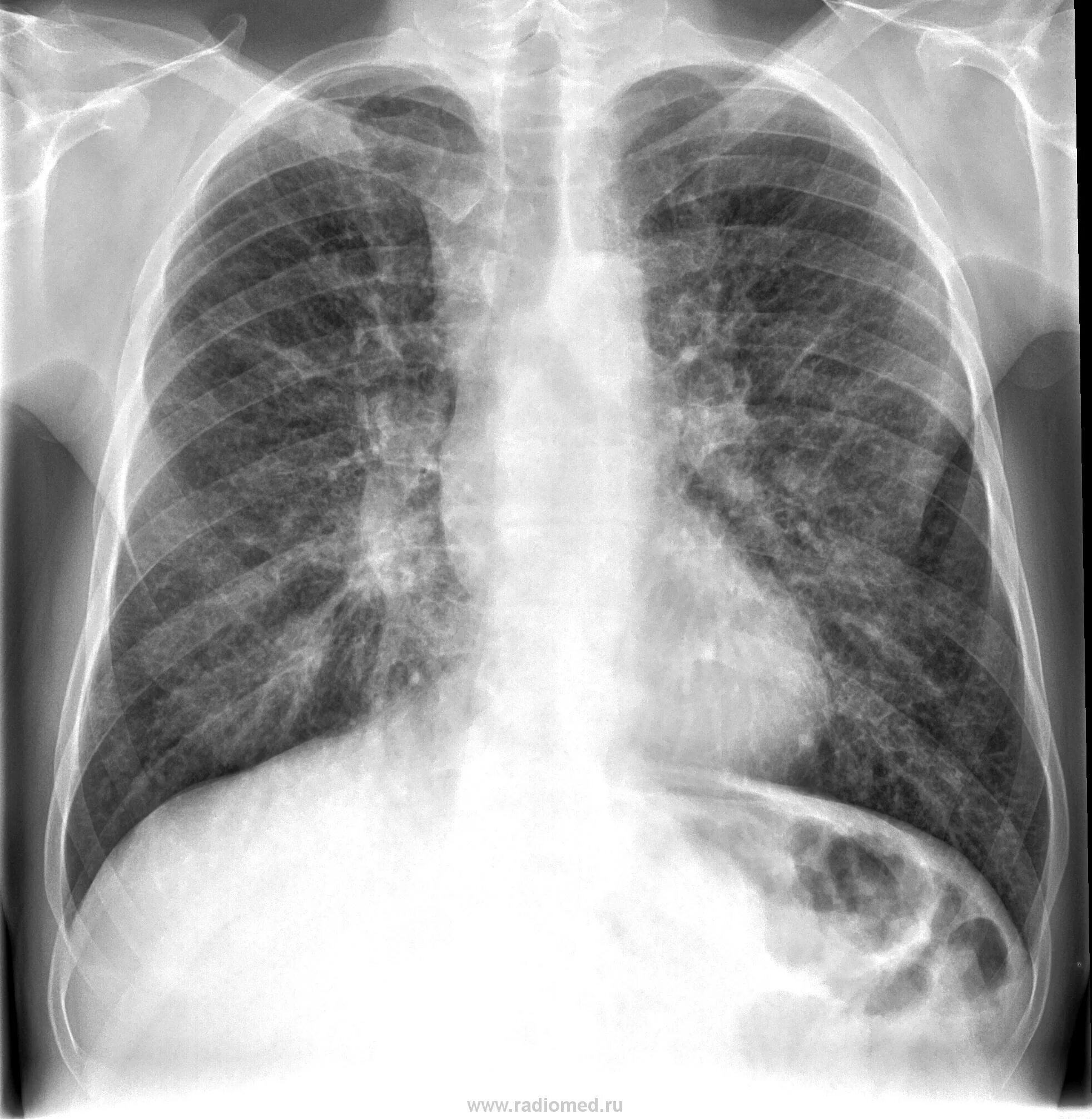 Тотальный пневмосклероз рентген. Постпневмонический пневмосклероз. Кардиогенный пневмосклероз. Рентген при пневмосклерозе.