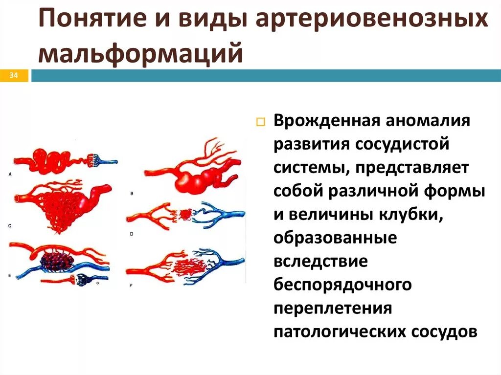 Сосудистая аномалия. Артериовенозные мальформации головного мозга классификация. Сосудистые мальформации головного мозга классификация. Капиллярная мальформация у новорожденных. Артериовенозный порок развития церебральных сосудов.