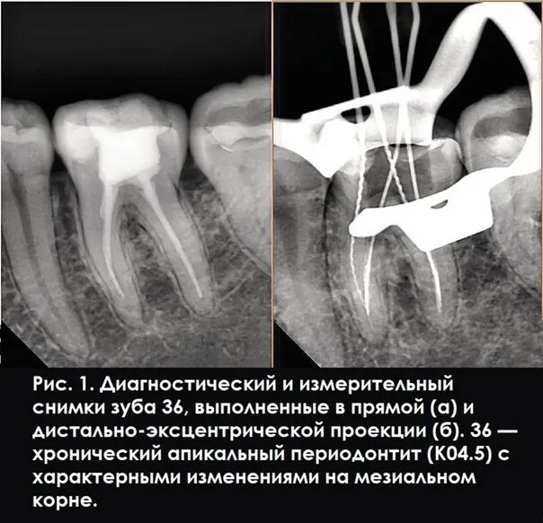 Как понять снимок зуба. Прицельная внутриротовая контактная рентгенография. рентгеновский снимок зуба. прицельный снимок зубов.