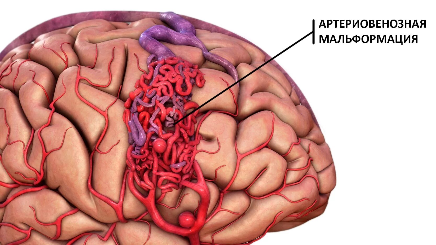 Инсульт левой артерии. АВМ мальформация сосудов головного мозга. Ртерио-венозная мальформация. Артериовенозная мальформация. Артериовенозные мальформации (АВМ) головного мозга..