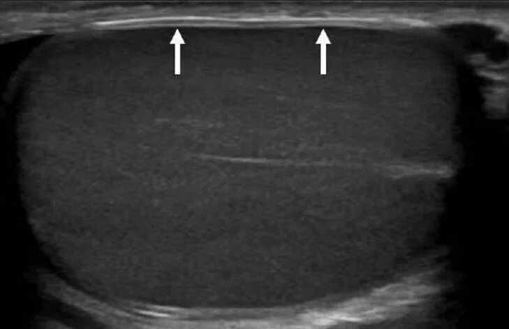 Семенной канатик на УЗИ мошонки. Орхоэпидидимит яичка УЗИ. Киста придатка яичка на УЗИ. Образование придатка яичка УЗИ. Водянка яичек симптомы и лечение