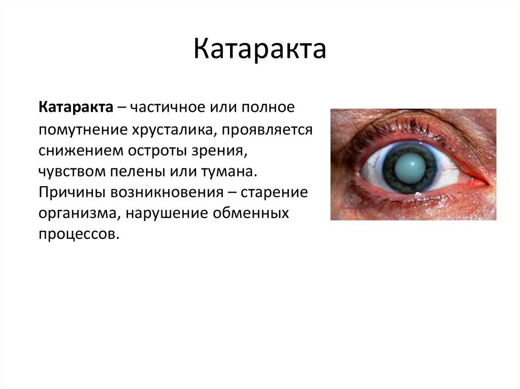 Передне капсулярная катаракта. Катаракта – помутнение хрусталика глаза.. Глазные болезни катаракта таблица.