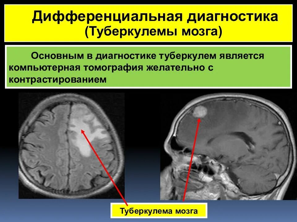 Туберкулома головного мозга. Туберкулема головного мозга на кт. Туберкулема головного мозга мрт.