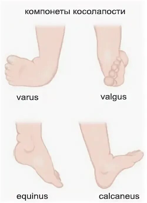 Эквинусная конская стопа. Пронация супинация в голеностопе. Эквинус голеностопных суставов. Эквинус стопы. Врожденная косолапость варус.