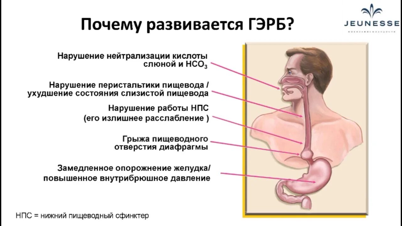 Раздраженный пищевод. Изжога причины. Пищеводные проявления ГЭРБ.