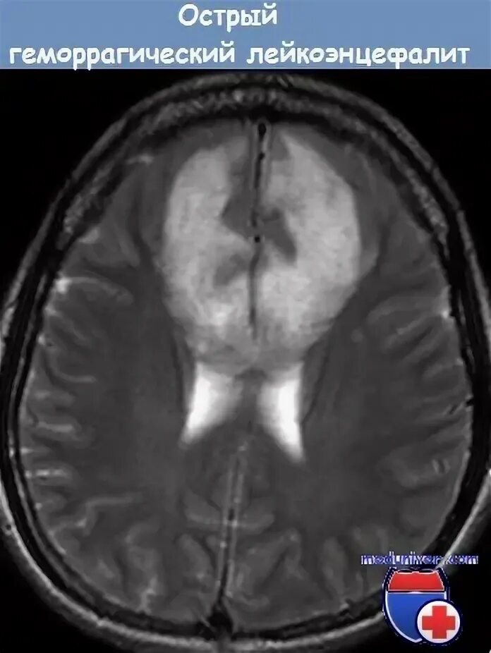 Лейкоэнцефалит. Острый геморрагический лейкоэнцефалит мрт. лейкоэнцефалит головного мозга на мрт. лейкоэнцефалит херста. мрт лейкоэнцефалит ван богарта.