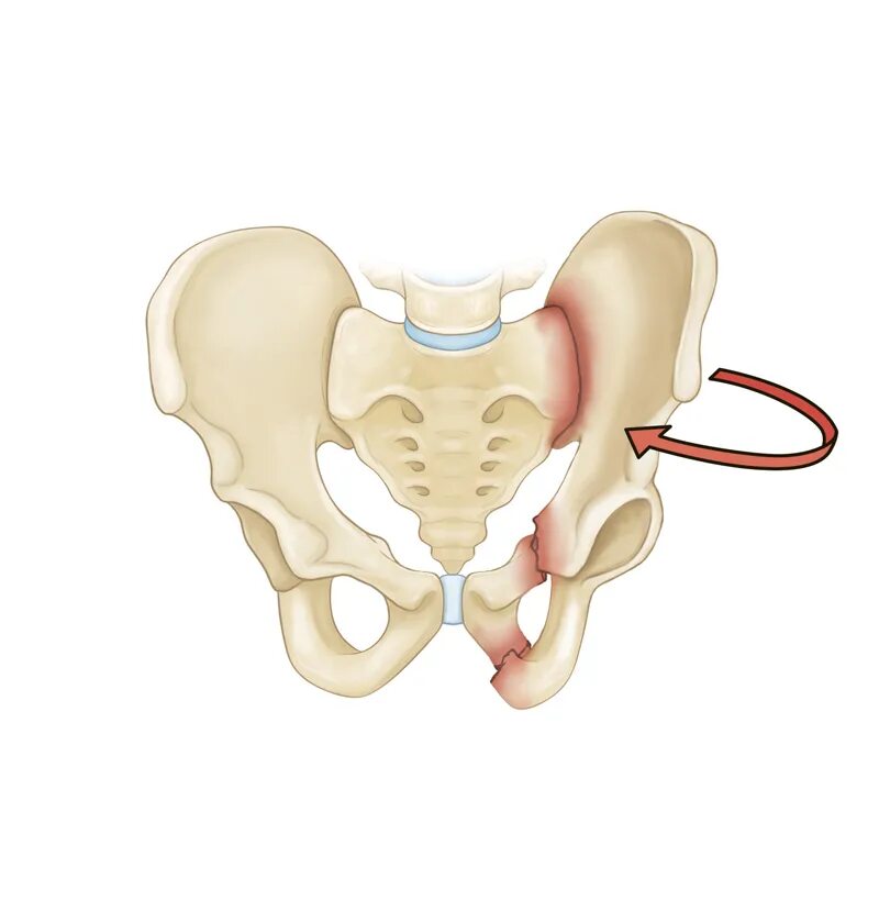 Крестец подвздошная кость. Крестец и таз. Тазовый крестец. Кости таза и крестец. Скрученный таз.