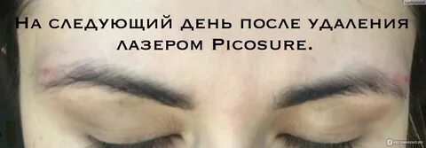 Удаление татуажа бровей пикашуром